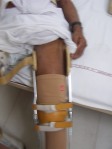 Thigh band removed so anterior aspect of the thigh is free ( sample photo: as the concerned patient with burn didn not allowed to put his photo on net.)